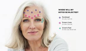 Check spelling or type a new query. How Long Does It Take For Botox To Work For Migraines