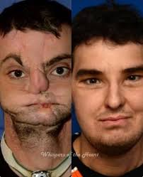 In 1997, Richard Norris's life was shattered by an accidental gunshot wound  that destroyed most of his face. For 15 years, he lived in isolation—hiding  behind a mask, unable to eat, speak,