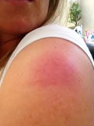 Tdap Reaction Question December 2014 Babies Forums What To Expect