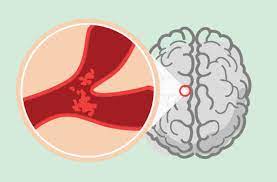 A stroke is a medical emergency, and prompt treatment is crucial. Why You Should Take Heed Of The Warning From A Mini Stroke Health Essentials From Cleveland Clinic