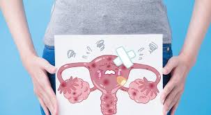 La maladie peut être asymptomatique. Endometriose Dieser Schmerz Ist Nicht Normal Bremervorder Anzeiger