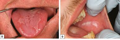 Racgp Common Benign And Malignant Oral Mucosal Disease