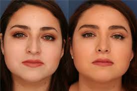 Rhinoplasty Before and After Photos by Ronald Schuster, MD; Lutherville, MD 