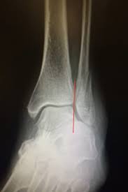 Image result for Ankle XRay
