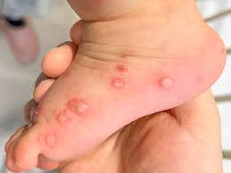 Image result for Hand foot and mouth disease HFMD roof of mouth