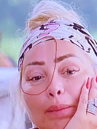 Did anyone notice Stacy's right eye….almost looks like a burn healing. You  can still see it under her makeup if you look. Dang, they need to learn  when enough is enough! |