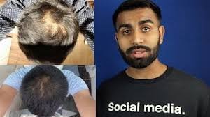 Nofap hair regrowth ( 100 % guaranteed ) | hindi this video is about nofap hair regrowth 5 free hacks to quit: Does Nofap Help Cure Hairloss Lifestyle Blog
