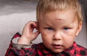 Mein Baby Hat Sich Den Kopf Gestossen Was Tun Besser Gesund Leben