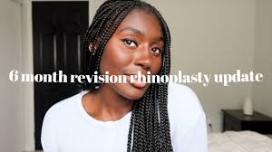 6 month revision rhinoplasty update