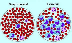 Este tipo de cáncer suele empeorar rápido si no se trata. Leucemia Mieloide Aguda Cancer Con Mayor Incidencia En Adultos Mayores El Periodico Usa En Espanol Del Rio Grande Valley Texas