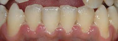 Untreated gingivitis usually progresses into the more serious stages of gum disease, which causes irreversible bone loss and potential tooth loss. Acute Necrotizing Ulcerative Gingivitis Wikipedia