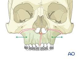 A Case Of Adult Cleft Palate Patient Treatment With Differential Maxillary  Lateral Expand Distraction Osteogenesis Using Combined Expansion Appliances  - Sciencedirect