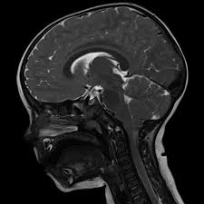 Totusi, hernia de disc apare adesea pe masura inaintarii in varsta, cand discurile intervertebrale isi pierd o parte din continutul de apa, iar ligamentele cu ajutorul imagisticii, prin rezonanta magnetica se obtin imagini 3d ale coloanei vertebrale si ale structurilor invecinate. Imagistica ModernÄƒ Cum FuncÈ›ioneazÄƒ Rmn Ul Tomografia È™i Ecografia Nwradu Blog