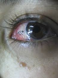 Image result for lesion sclera