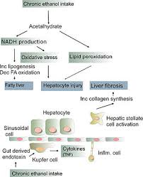 alcoholic liver disease wikipedia