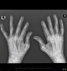 In rheumatoid arthritis, the body's immune system attacks its own healthy cells inside certain joints, leading to an inflammatory response. Rheumatoid Arthritis Musculoskeletal Manifestations Radiology Reference Article Radiopaedia Org