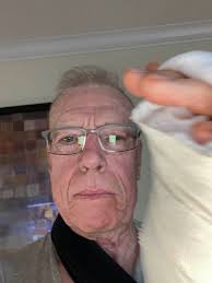 Left hand done, right will be next, dupuytrens!