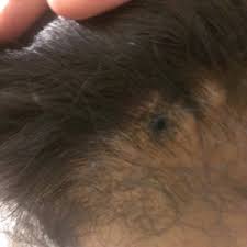 The area is cleaned with antimicrobial agents then the area is numbed with a local anesthetic. 2 Shave Biopsy Performed On Scalp Will My Hair Grow Back On Those Areas How Long Will It Take To Heal Photos