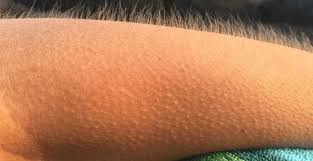 Why Do We Get Goosebumps And like other smooth muscles of the body—those that handle digestion, blood flow, respiration, and so on—they are unconsciously. why do we get goosebumps
