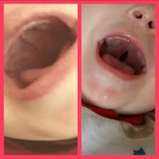 Cleft palate and cleft lip surgery procedures. Cleft Lip Palate Association