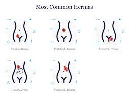 We did not find results for: What Is A Hernia Types Symptoms Treatment And Prevention