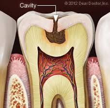 Maybe you would like to learn more about one of these? Fillings Dentist La Grande Or Dental Education Library