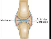 Image result for what happens if you don't seek treatment for bone on bone knee