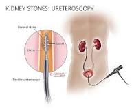Image result for what is treatment for urethral calculi