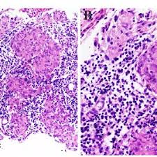 The cause of sarcoidosis is unknown. Pdf Lung Cancer Or Sarcoidosis A Diagnostic Dilemma