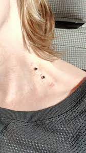 Repositioned Dermal 3 Days Post Piercing Healing Well Dermal Piercing Piercing Belly Button Rings