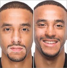 Vitiligo Concealer Starter Kit