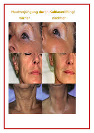 Monika Krack - Wellness der besonderen Art: Vitalaser- - vorher-nachher_mit_Rahmen