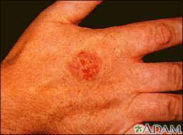 According to the american cancer society, just over 100,000 new cases of skin cancer are diagnosed in the united states each year. Squamous Cell Skin Cancer Information Mount Sinai New York