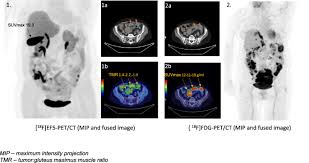 Symptoms of ovarian cancer can include: The Feasibility Of 18f Ef5 Pet Ct To Image Hypoxia In Ovarian Tumors A Clinical Study Ejnmmi Research Full Text