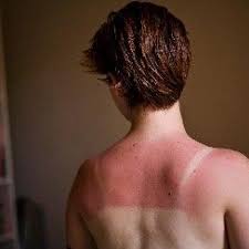 Nos conseils lorsqu'il s'agit de coups de soleil. Reparer Un Coup De Soleil Conseils Et Astuces