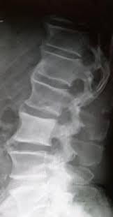 Picture frame vertebra pic·ture frame ver·te·bra radiographically diminished density of trabecular bone with relative preservation of the cortex, a sign of osteopenia. Epos Trade