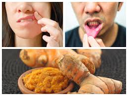 How to treat ulcers naturally. What Are Mouth Ulcers How Turmeric Helps In Treating Mouth Ulcers Times Of India