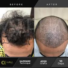 Hair Transplant In Turkey Greffe De Cheveux Greffe Cheveux