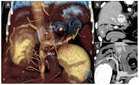 Learn more about portosystemic shunts in dogs. Veterinary Sciences Free Full Text Anomalies Of The Portal Venous System In Dogs And Cats As Seen On Multidetector Row Computed Tomography An Overview And Systematization Proposal Html