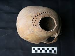 1 000 Years Ago Patients Survived Brain Surgery But They Had To Live With Huge Holes In Their Heads Smart News Smithsonian Magazine
