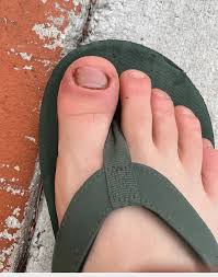 Image result for Onychotillomania feet