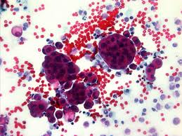 Neoplastic transformation of mesothelial cells results in malignant mesothelioma, an aggressive tumor, especially the pleura. Benign And Malignant Mesothelial Proliferation Surgical Pathology Clinics