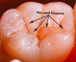 What is sealant for teeth. Faq What Are Sealants Shelby Pediatric Dentistry Dental Care For Kids Birmingham Al