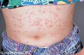 Maybe you would like to learn more about one of these? Hot Tub Folliculitis American Osteopathic College Of Dermatology Aocd
