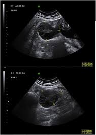 An ultrasound may spot a mass, but it can't determine whether that mass is cancerous or benign. Ultrasound Scan Of The Right Ovary At 18 Weeks Gestation Upper Image Download Scientific Diagram