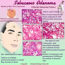 Pathology Sebaceous Adenoma Pathology Medicine Notes Human Anatomy And Physiology