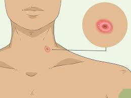 skin cancer is very treatable when caught early. How To Check For Skin Cancer 9 Steps With Pictures Wikihow