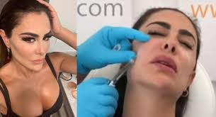 Ninel también se sometió a un eyebright, que el sitio oficial del cirujano describe como una técnica que ayuda a aminorar las ojeras y bolsas, así como a suavizar las líneas de expresión, sin provocar moretones ni sangrado. Ninel Conde Y Sus Cirugias Filtran Video Sometiendose A Tratamiento Estetico Actitudfem