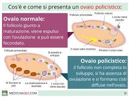Quali ormoni scatenano la sindrome dell' ovaio policistico? Ovaio Policistico Sintomi Cause Dieta E Cura Della Sindrome