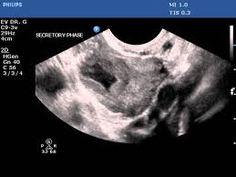 Image result for corpus luteum sonography)
